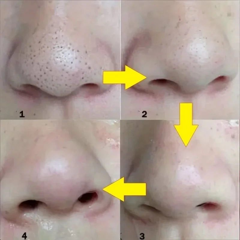 15pcs Blackhead Nose Strips